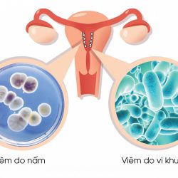 Nguyên nhân gây dấu hiệu viêm âm đạo do đâu? 