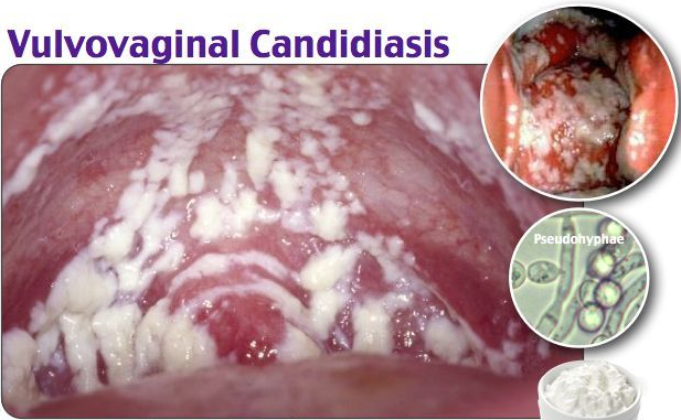 Hình ảnh viêm âm đạo do nấm Candida gây ra