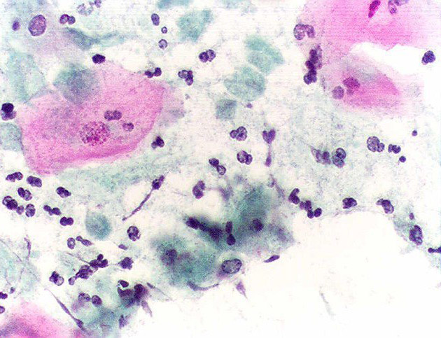 Hình ảnh viêm âm đạo do trùng roi Trichomonas