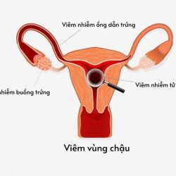 3 Nguyên nhân chính gây bệnh viêm vùng chậu ở nữ giới