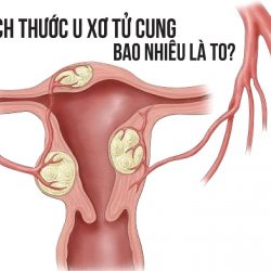 Kích thước nhân xơ tử cung thế nào thì cần điều trị?