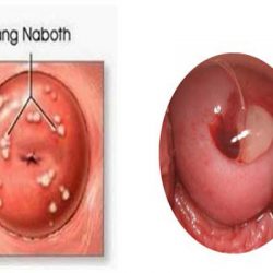 Cổ tử cung có hạt nhỏ do nang naboth cổ tử cung