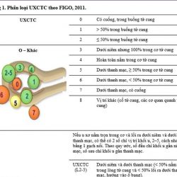 Nhân xơ tử cung có mấy loại? Đặc điểm cụ thể của từng loại 