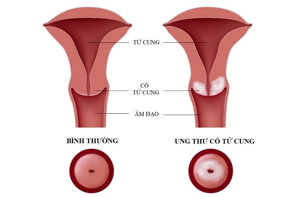 Biến chứng của bệnh đa nang buồng trứng là Ung thư tử cung