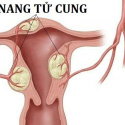 Dấu hiệu u nang tử cung là gì? U nang tử cung có nguy hiểm không?