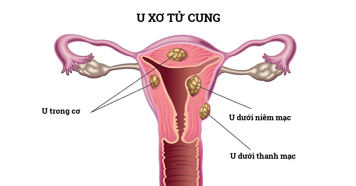 Khái quát về bệnh u xơ tử cung ở nữ giới