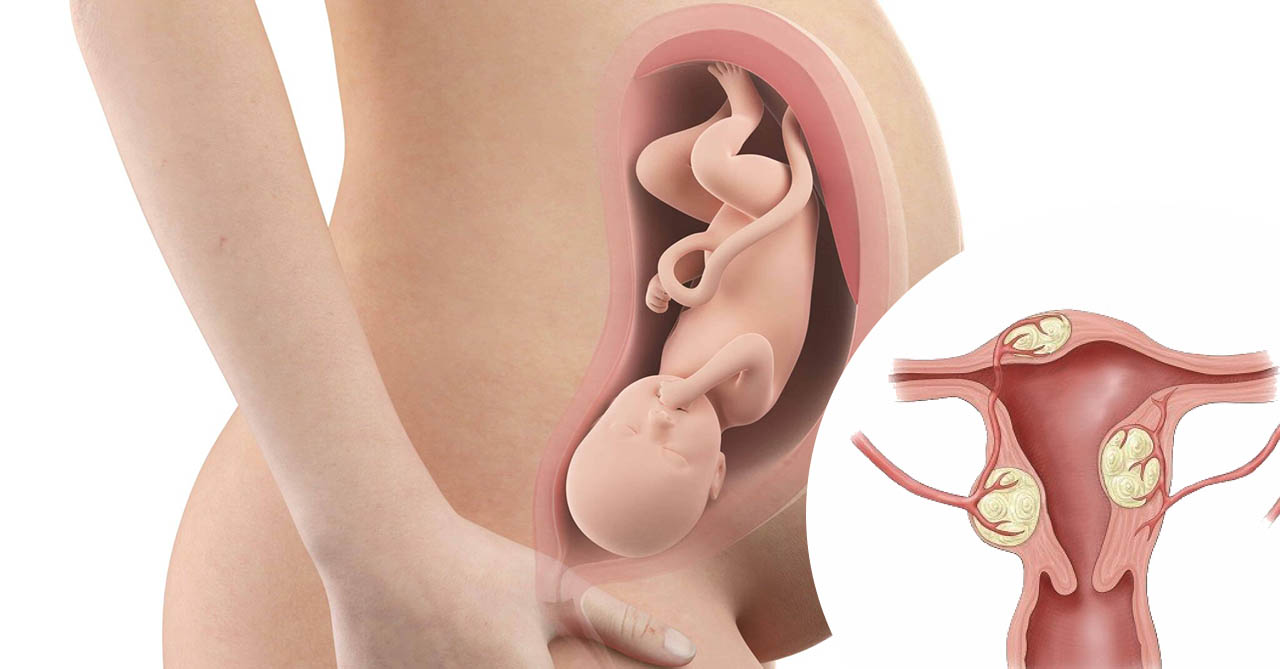 Mẹ bầu bị nhân xơ tử cung khi mang thai có sao không? 