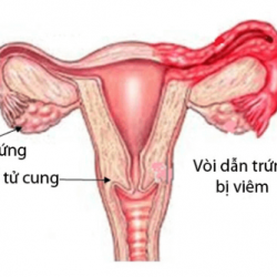 Những thông tin cần biết về bệnh viêm vòi trứng