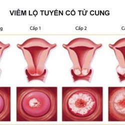 Viêm lộ tuyến cổ tử cung là gì? Những thông tin cơ bản cần nắm rõ