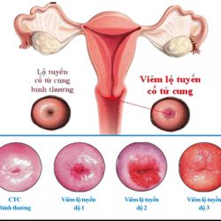 Dấu hiệu khỏi viêm lộ tuyến cổ tử cung là gì? Địa chỉ chữa khỏi bệnh uy tín