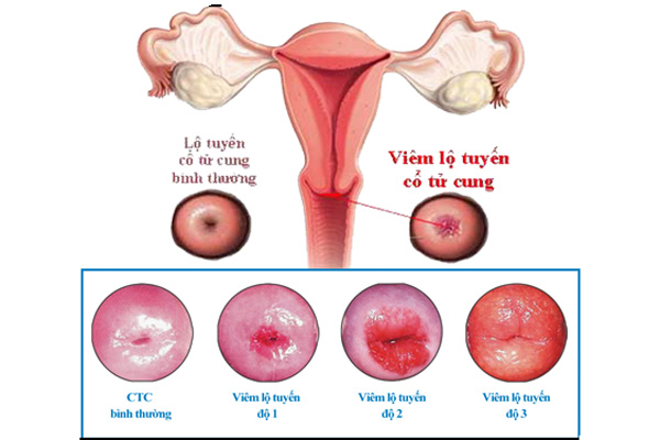 Hình ảnh viêm lộ tuyến cổ tử cung - Tổng quan về bệnh 