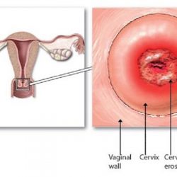 Viêm lộ tuyến cổ tử cung dạng sùi có nghiêm trọng không, chữa viêm lộ tuyến bằng cách nào?