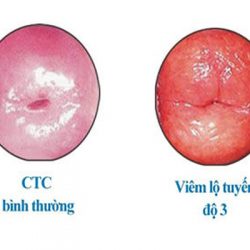 Viêm lộ tuyến cổ tử cung cấp độ 3 và cách điều trị dứt điểm, an toàn