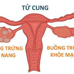 Đa nang buồng trứng: