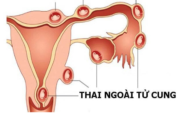 Mang thai ngoài tử cung 
