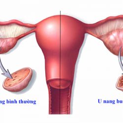 Bệnh u buồng trứng có nguy hiểm không, liệu có cần phải đề phòng?