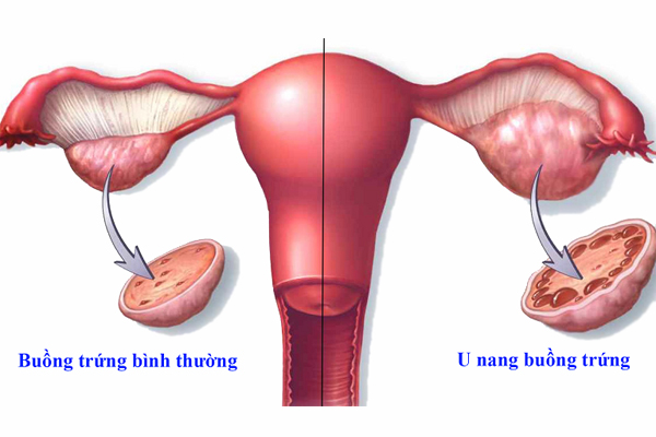 Sự khác nhau giữa buồng trứng bình thường và u nang buồng trứng 