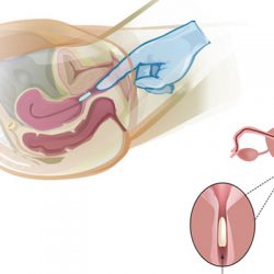 5 Lưu ý khi đặt thuốc phụ khoa - 2 Cách đặt thuốc phụ khoa đúng nhất