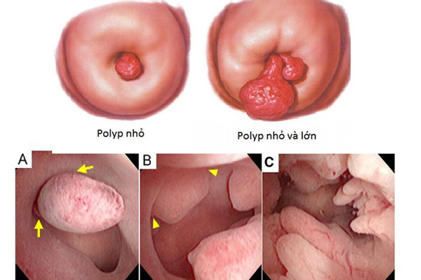 Những thông tin chi tiết về bệnh polyp cổ tử cung