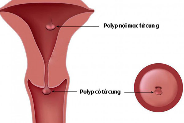 Polyp cổ tử cung và những ảnh hưởng tiêu cực