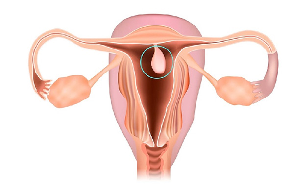 Bệnh polyp cổ tử cung là gì ?