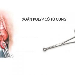 Giải đáp cho người bệnh: Sau khi xoắn polyp cổ tử cung có dễ tái phát hay không?