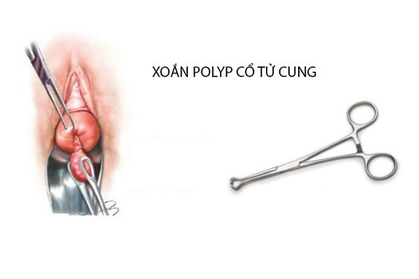 Phương pháp xoắn polyp cổ tử cung ở cuống