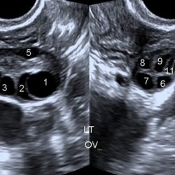 Hình ảnh đa nang buồng trứng trên siêu âm chi tiết nhất