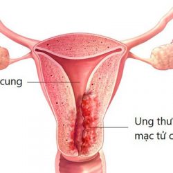 Chuyên gia cho biết bệnh đa nang buồng trứng có chữa được không