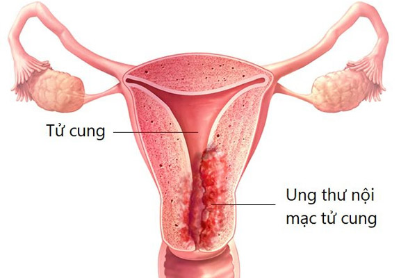 Có nguy cơ ung thư nội mạc tử cung 
