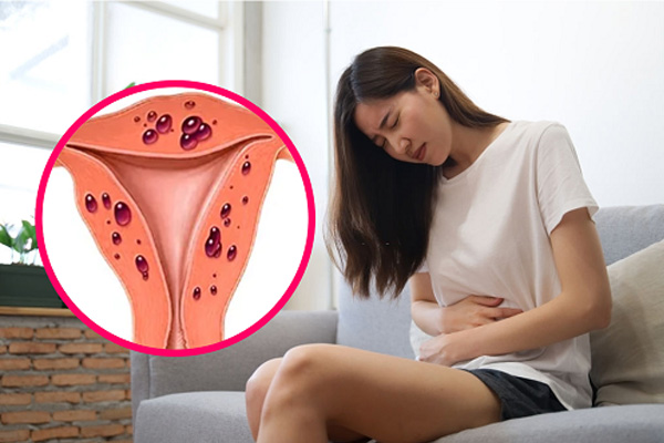 Lạc nội mạc cơ tử cung vì nguyên nhân nào mà xuất hiện?