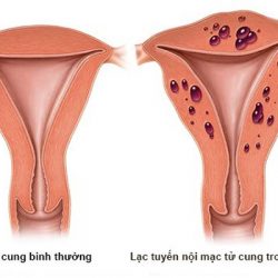 Giúp bạn nhận biết hình ảnh lạc nội mạc tử cung