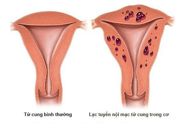 Hình ảnh lạc nội mạc tử cung