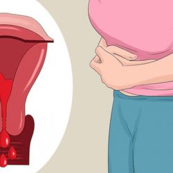 Cơn đau lạc nội mạc tử cung do đâu mà có, làm sao để khắc phục?